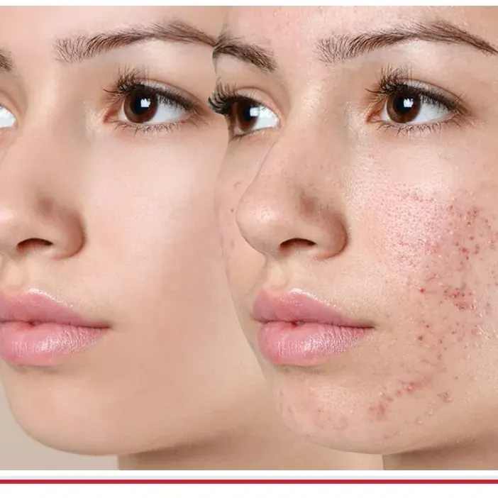 Acne Treatment in Aligarh — Dr. Amit Agrawal