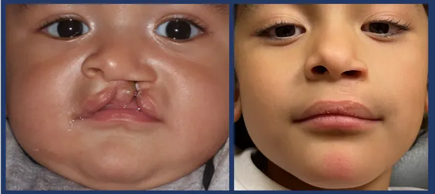 Cleft Lip Surgery in Aligarh — Dr. Amit Agrawal