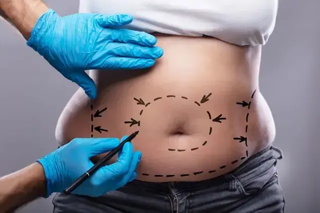 Liposuction in Aligarh — Dr. Amit Agrawal