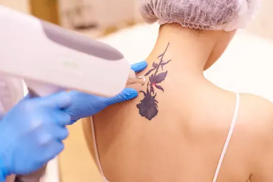 Tattoo Removal in Aligarh — Dr. Amit Agrawal