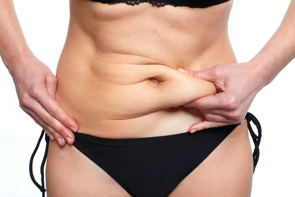 Abdominoplasty