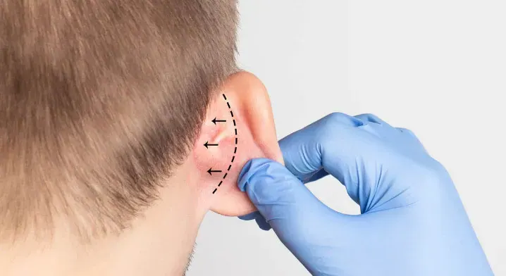 Otoplasty