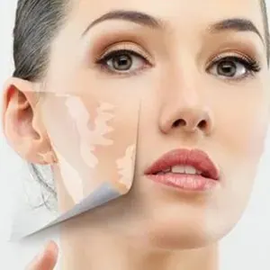 Scar Surgery