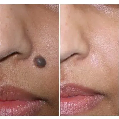 Mole Removal