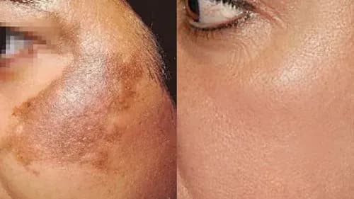 Pigmentation